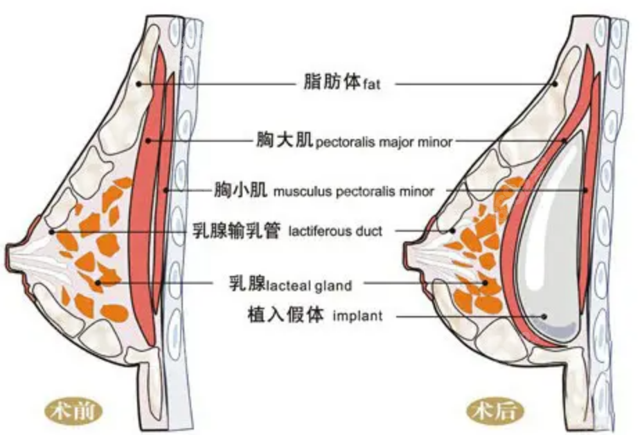 韩国必当归隆胸