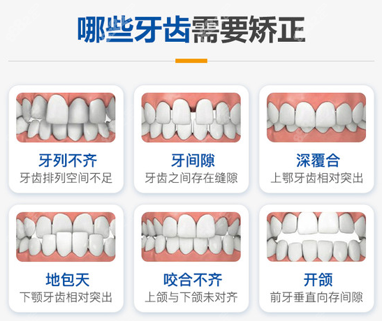 兰州德尔牙科常做的牙齿矫正类型