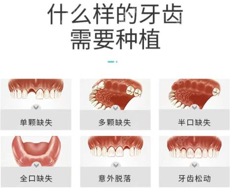 兰州皓亚口腔做种植牙的类型