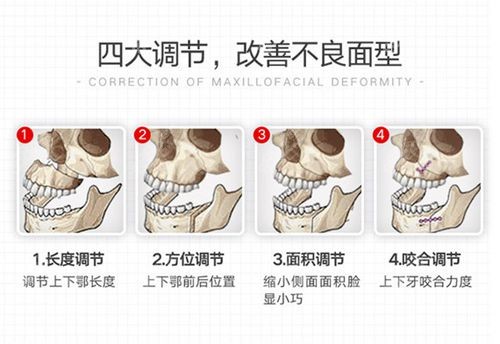 正颌手术原理