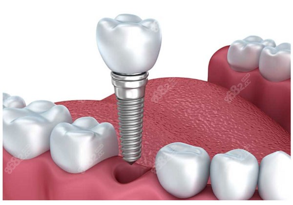团圆口腔种植牙