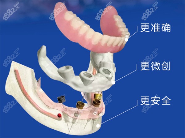 中诺口腔立得用种植牙优势