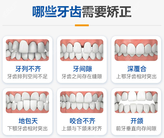 兰州皓亚口腔做牙齿矫正的类型