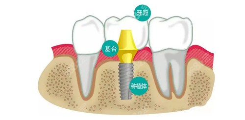 种植牙示意图