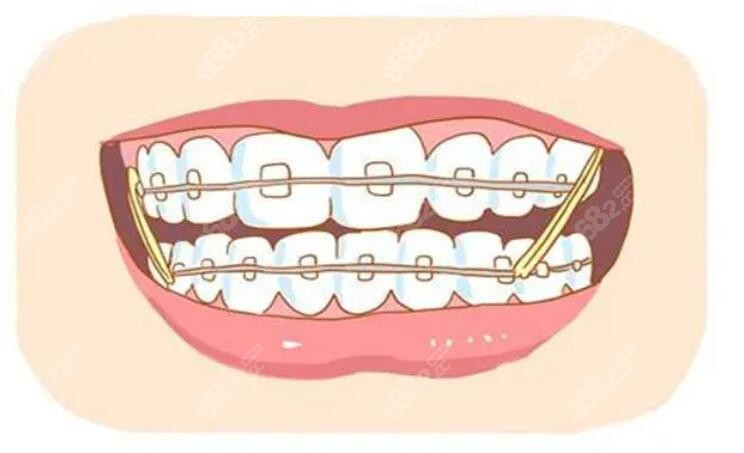牙齿矫正卡通图