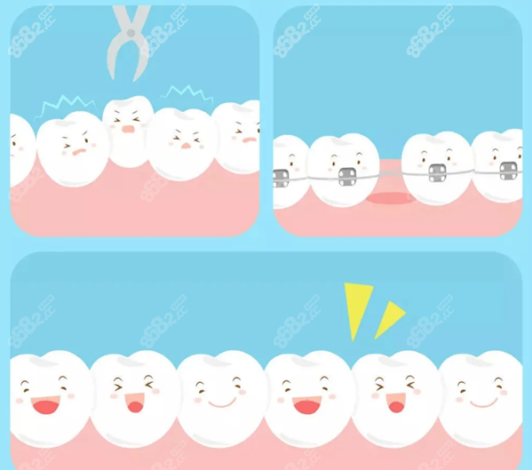贝臣口腔种植一颗牙多少钱
