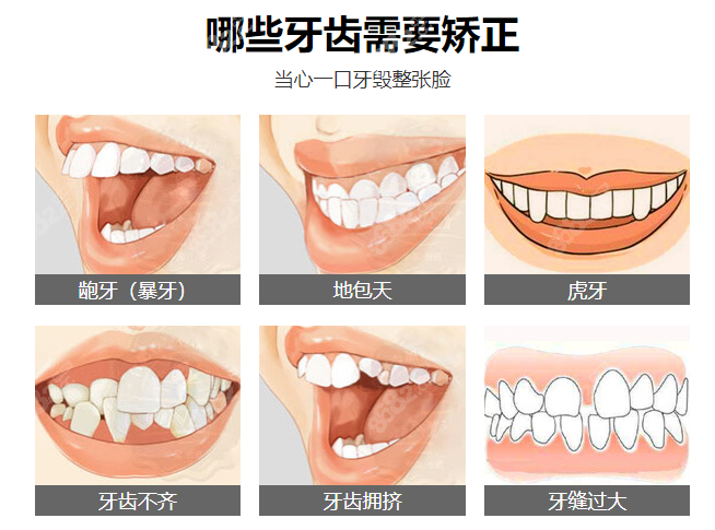 广州公办医院牙齿矫正多少钱啊