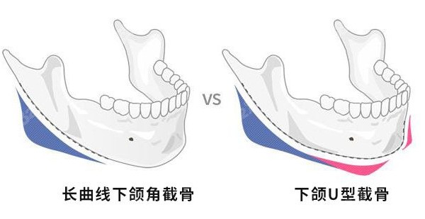 长曲线下颌角截骨和下颌U型截骨对比