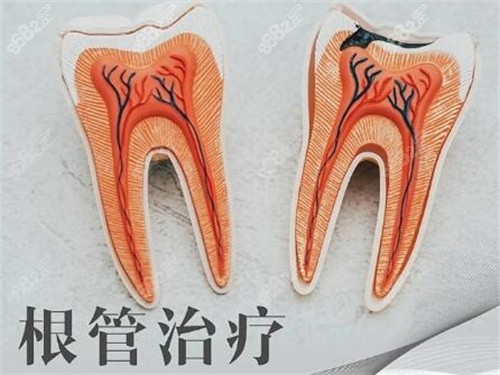 南宁牙博士口腔根管治疗