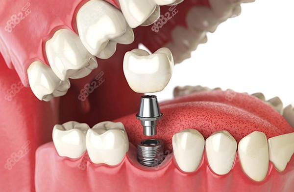 石家庄中诺口腔医院种植牙价格