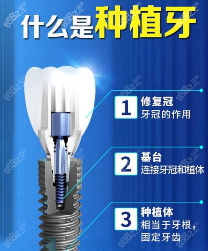 纽大口腔医院种植牙