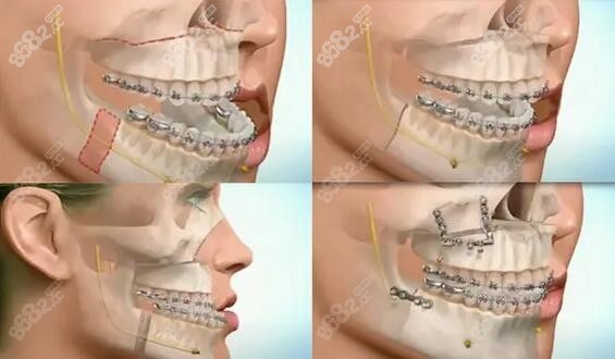 不同的正颌手术方式