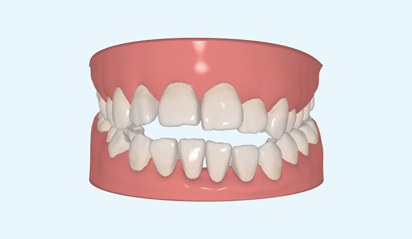 牙齒矯正示意圖