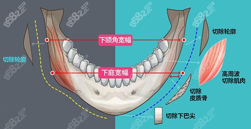 赵延峰做下颌角怎么样