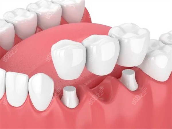 北京口腔医院牙冠保修期是多长时间，可以报销吗