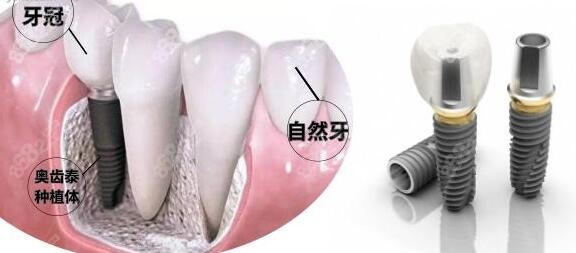 种植牙价格介绍