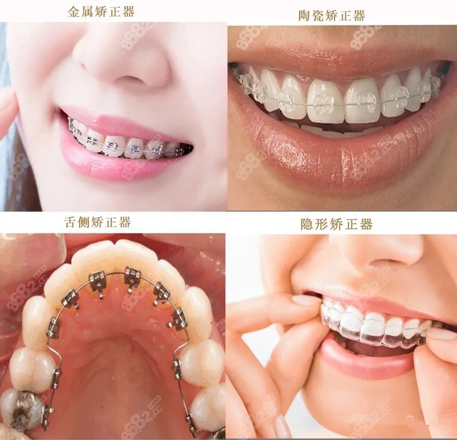 维乐口腔医院牙齿矫正类型