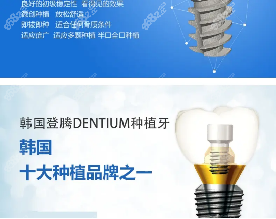 韓國(guó)登騰種植體適合即刻種植