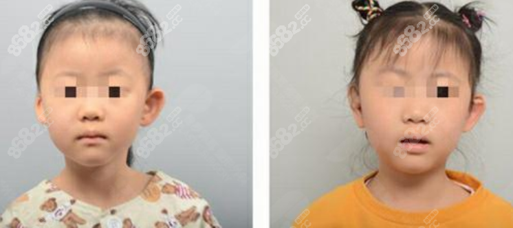 韩国普罗菲耳郑在皓耳再造真人图好看