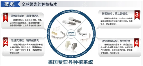 德國(guó)費(fèi)亞丹種植體