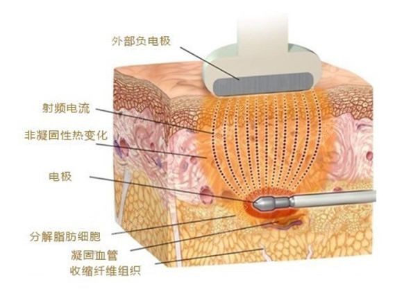 黄金微雕吸脂的原理