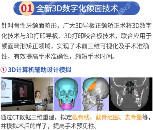 广州广大3D数字化导板正颌矫正龅牙优势