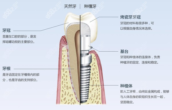 青岛维乐口腔种植牙价格