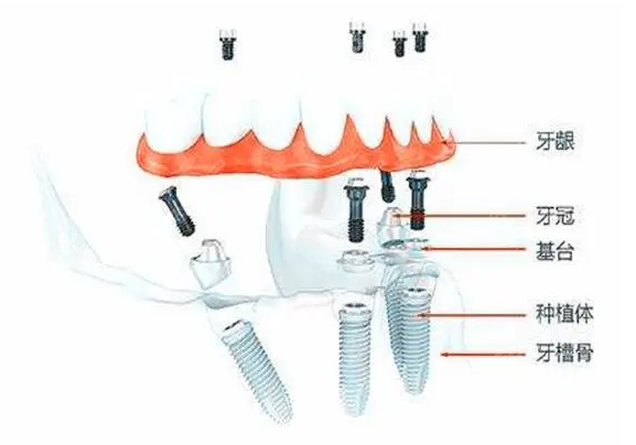 適合做即刻種植的種植體