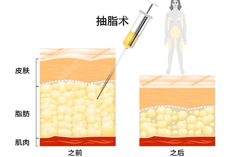 正规医院为什么不做抽脂手术？