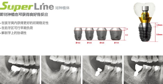 韩国登腾种植牙优势