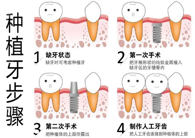 枣庄种植牙齿步骤