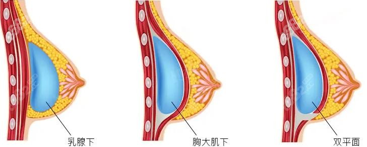 隆胸的3个切口选择