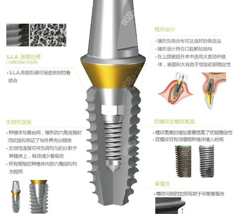 韩国登腾种植牙质量如何