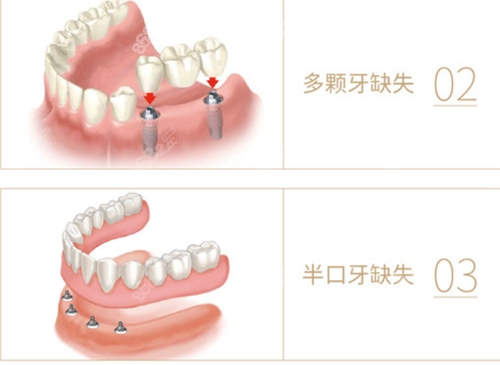 宝山区口腔医院种植牙价格表