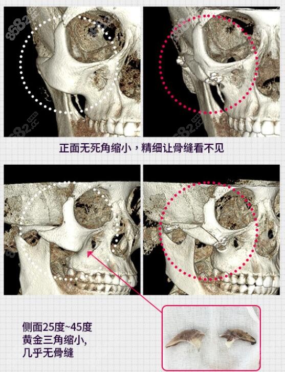 金镇亨是韩国做颧骨内推好的医生