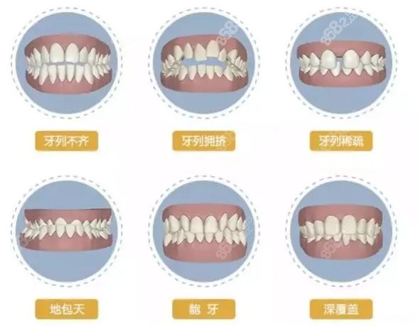 口腔牙齿矫正类型