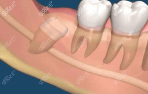 牙根紧贴或骑在神经线上的智齿