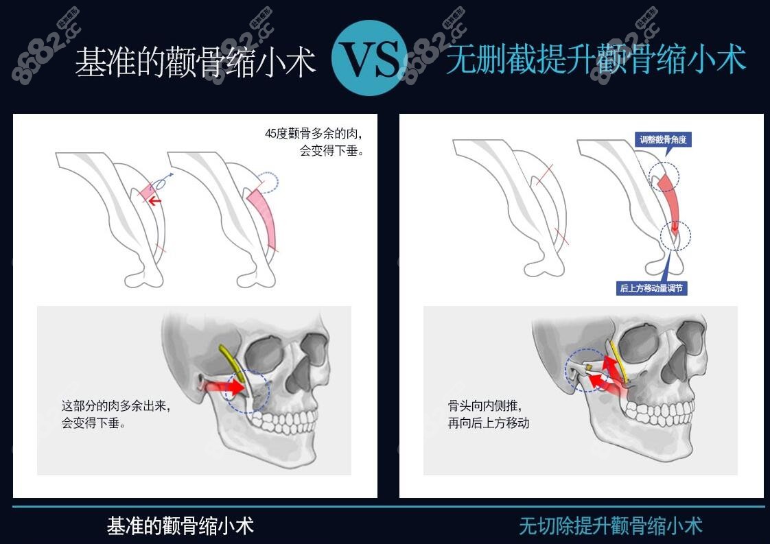 李真秀颧骨内推技术