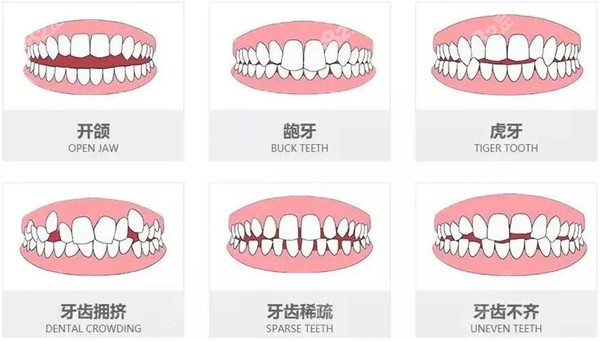 牙齿矫正类型