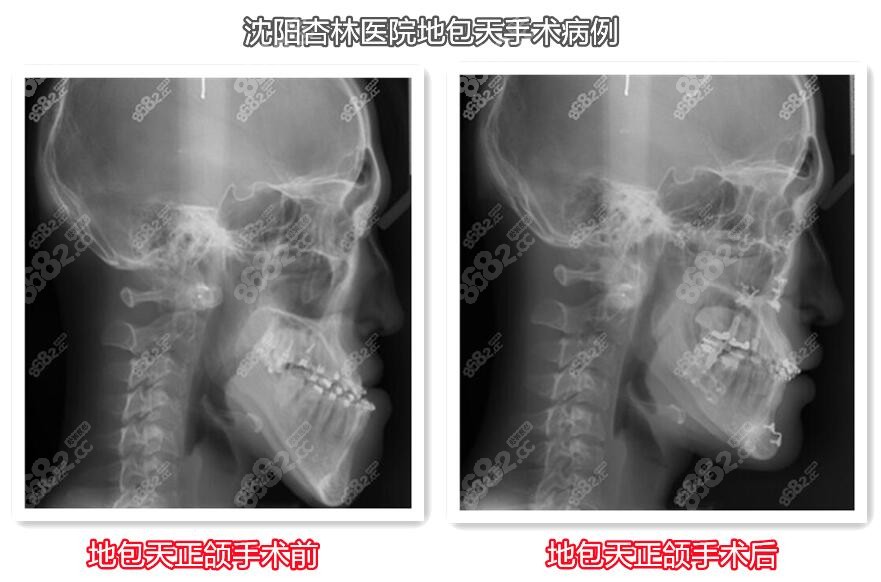 沈陽杏林醫(yī)院地包天手術(shù)病例