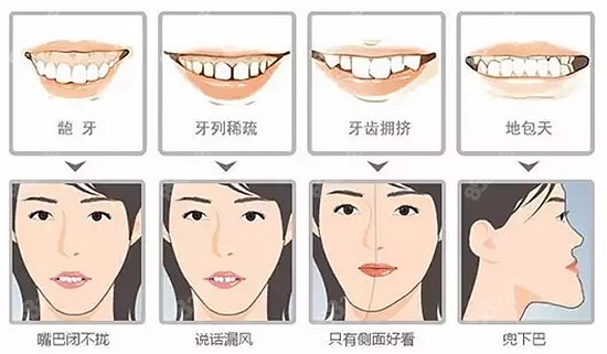 常德牙齿深覆盖矫正费用