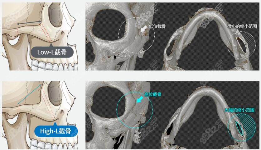 李知赫院长是韩国颧骨手术医生排名靠前的一位