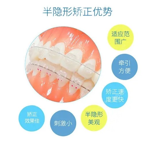 陶瓷托槽半隐形矫正牙齿