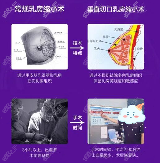 垂直切口乳房缩小术的优势