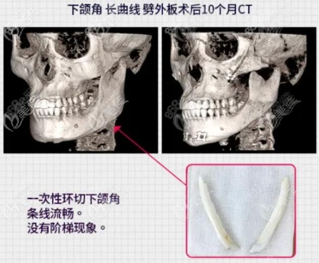 长曲线下颌角整形优势