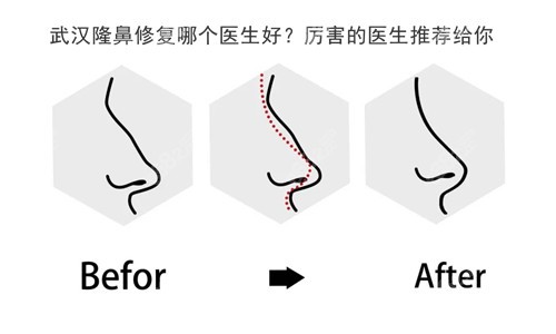 武汉修复鼻子厉害的医生