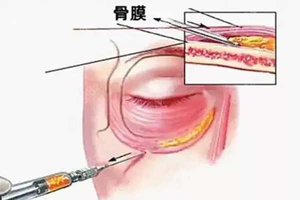 爱贝芙填充层次