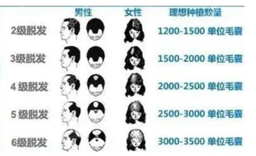 不同脱发等级对应的植发数量