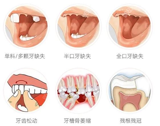 上海雅康美口腔种植牙适应类型