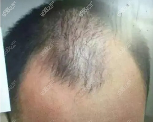 植发后还会脱发吗